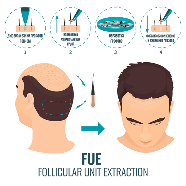 ​Пересадка волос методом FUE