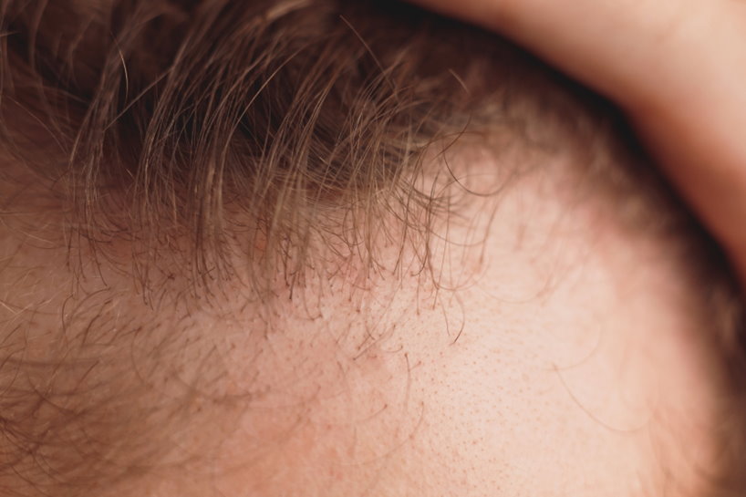 Можно ли остановить выпадение волос после химиотерапии?