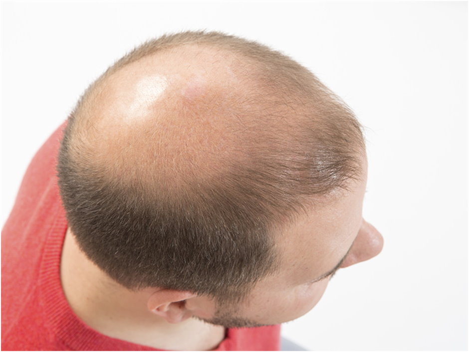 Аюрведическое лечение выпадения волос