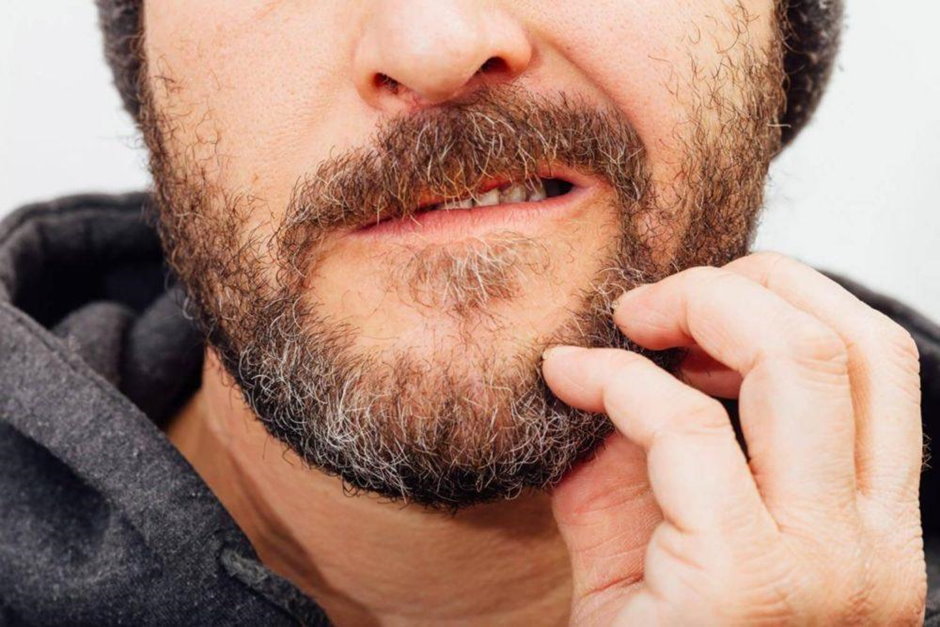 нарушение роста бороды
