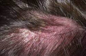 аллергический дерматит кожи головы