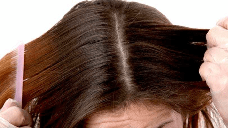 Сухая кожа головы — в чем причины и что с этим делать?