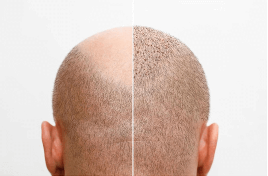 Этапы роста и восстановления волос после пересадки через 1, 2, 3 месяца